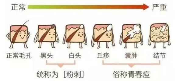 脸上的白头粉刺怎么去除简单方法,白头粉刺刺破变成红点