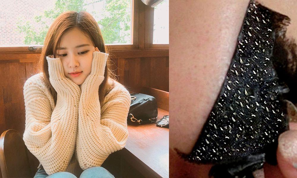 黑头贴吸出来的是粉刺还是黑头,去黑头闭口粉刺用黑头贴可以吗