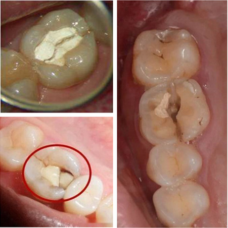 根管治疗后牙齿一定要装牙套吗,根管治疗戴牙冠后有什么感觉