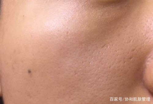 脸上的痘坑痘印怎么消除,脸上很多坑如何修复