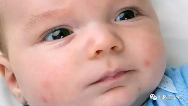 怎么分辨宝宝热疹湿疹荨麻疹,幼儿急疹和湿疹风疹有什么区别