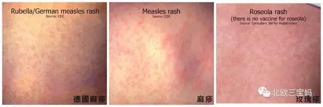 怎么分辨宝宝热疹湿疹荨麻疹,幼儿急疹和湿疹风疹有什么区别