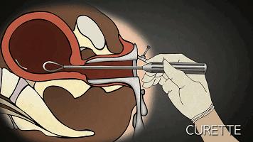 堕胎是杀人吗,堕胎就是杀生