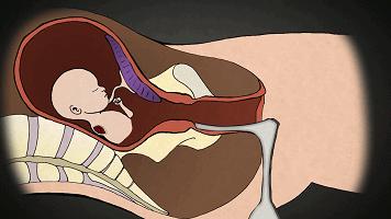 堕胎是杀人吗,堕胎就是杀生