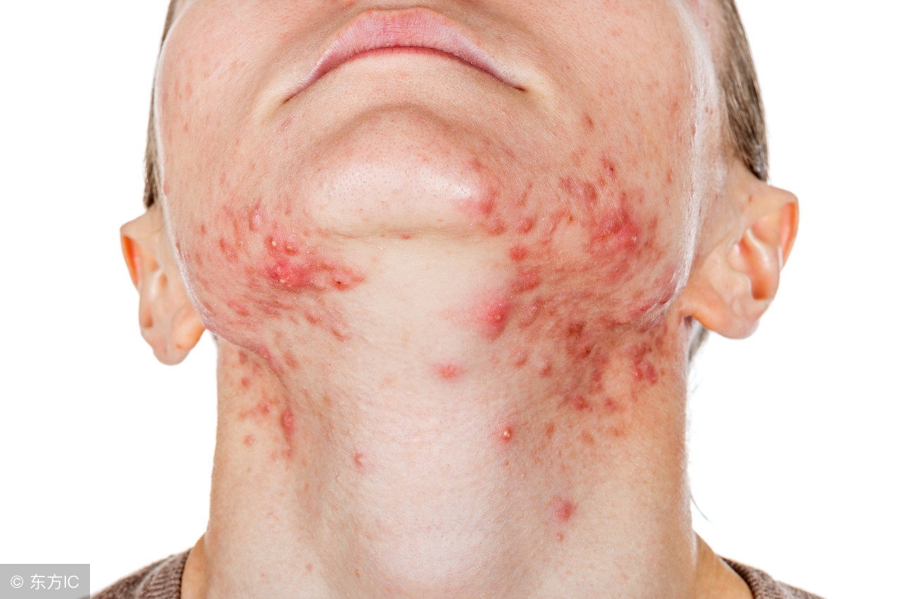 螨虫特别顽固,在家里发现螨虫怎么彻底根除