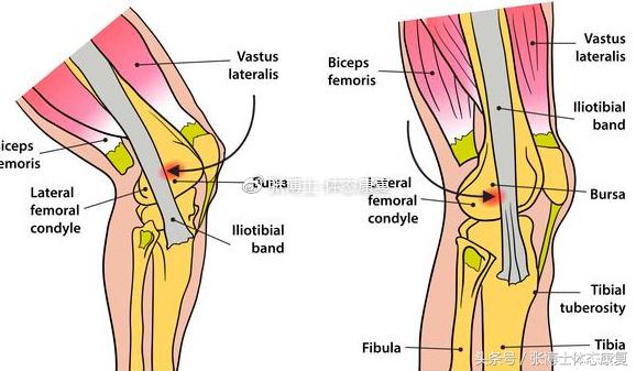 运动康复跑步膝盖疼,髂胫束摩擦综合征还能跑步吗