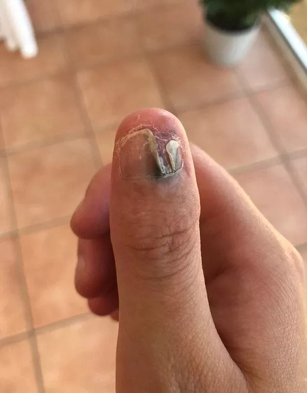 咬指甲手指被截肢,女大学生咬指甲