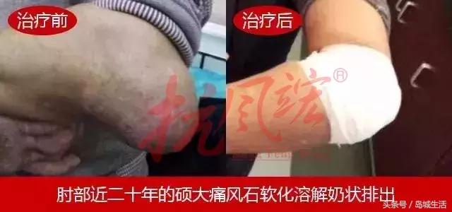 痛风久治不愈怎么办,痛风治疗这四件事真的很重要