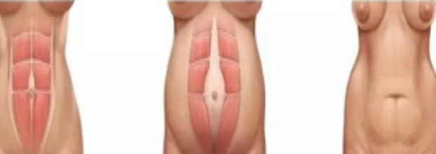 为什么孕妇会出现单脐动脉,孕妇为什么会是悬垂腹呢