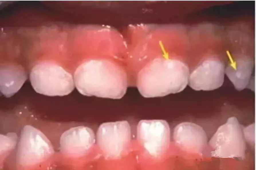 2岁宝宝牙齿全烂光，这5个问题不及时处理，孩子将来恨你一辈子