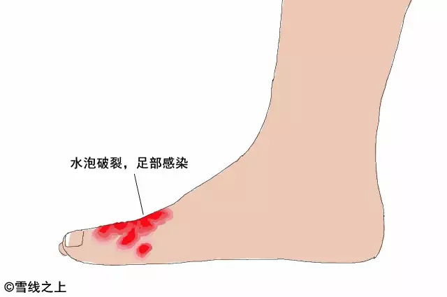 陶冶重庆｜徒步时，如何防治水泡？