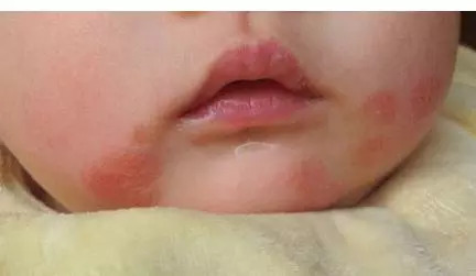 成年人反复湿疹的最佳治疗方法,湿疹水泡反复发作有没有土方法