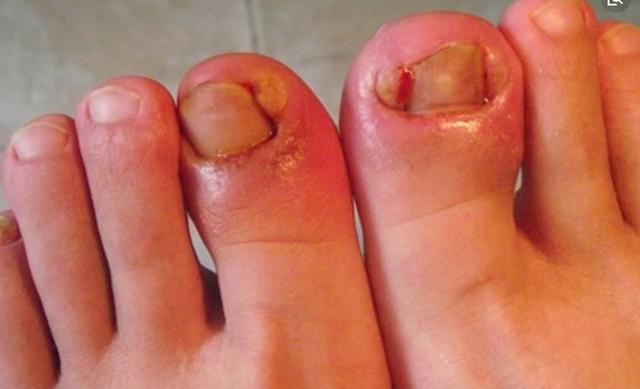 甲沟炎居然无需拔甲？这样治就能治好甲沟炎！