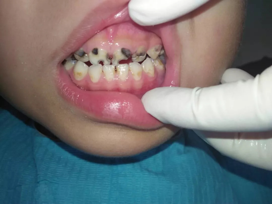 孩子蛀牙不会痛，医生为啥要杀死牙神经！你家娃中招了吗？