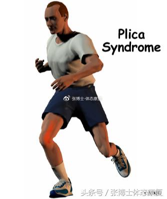 膝关节滑膜皱襞综合征锻炼,膝关节滑膜皱襞综合征怎么治