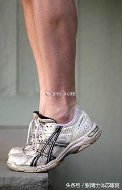 膝关节滑膜皱襞综合征锻炼,膝关节滑膜皱襞综合征怎么治