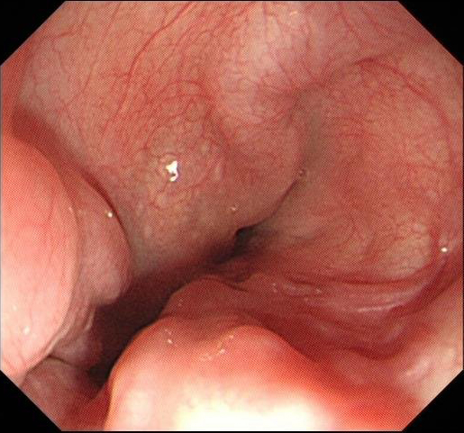 肝硬化中西医结合治疗并发症,肝硬化tips介入手术并发症