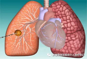 肺癌的诊断+综合介入治疗（穿刺活检+肿瘤血管栓塞+消融+碘125例子植入）—运城市第一医院肿瘤微创及综合介入科