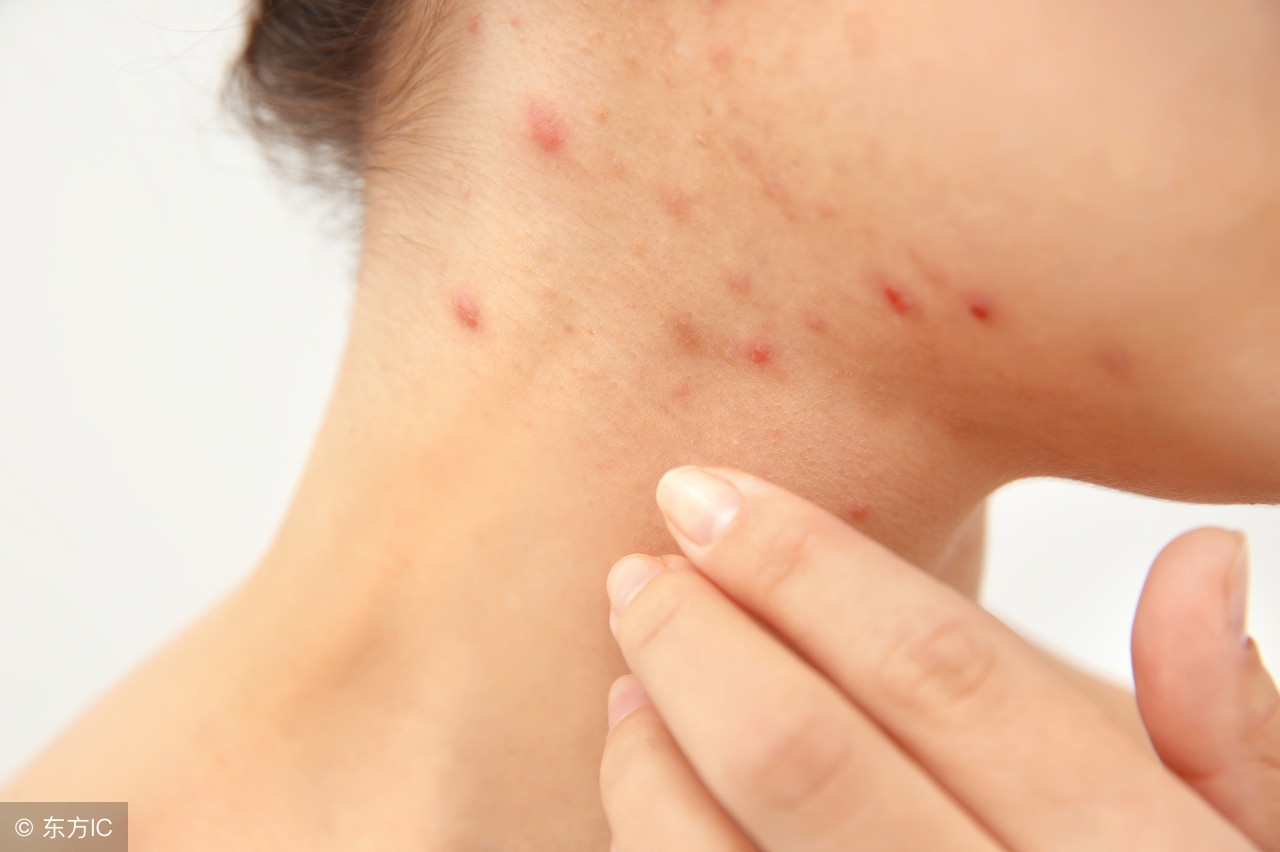 床垫有螨虫小孩睡了过敏,螨虫过敏者铺什么床垫最好