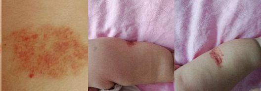 婴幼儿血管瘤怎么治疗效果好,婴幼儿血管瘤最好的治愈方法