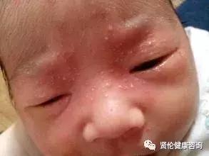 为新妈咪做婴儿湿疹护理的指导,对付湿疹口服的特效药