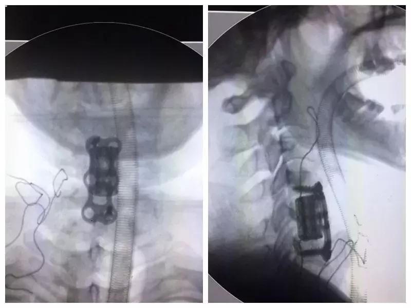 高科技治疗截瘫,高位截瘫治疗科技