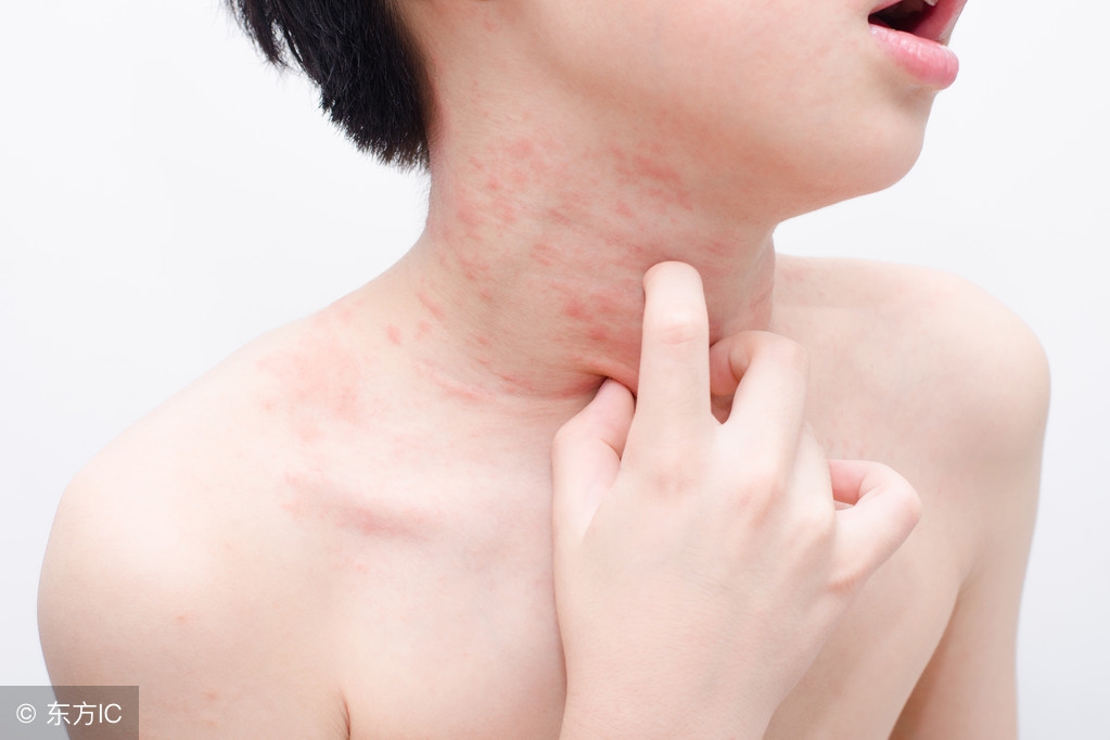 荨麻疹属于麻疹类型吗,得荨麻疹丘疹几天可以好