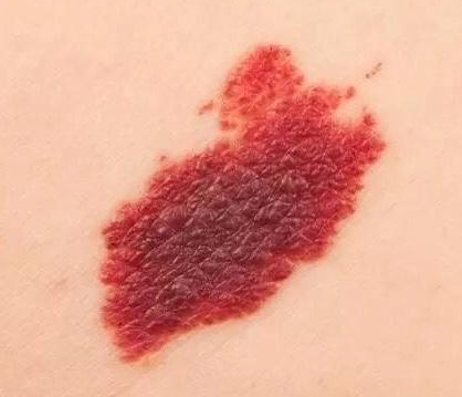 宝宝身上有大面积咖啡色胎记,宝宝胎记黑色斑块图片