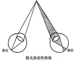 近视双眼差距300怎么办,双眼相差300度不戴眼镜