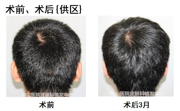 5个原因导致男人脱发,雄激素性脱发能治吗