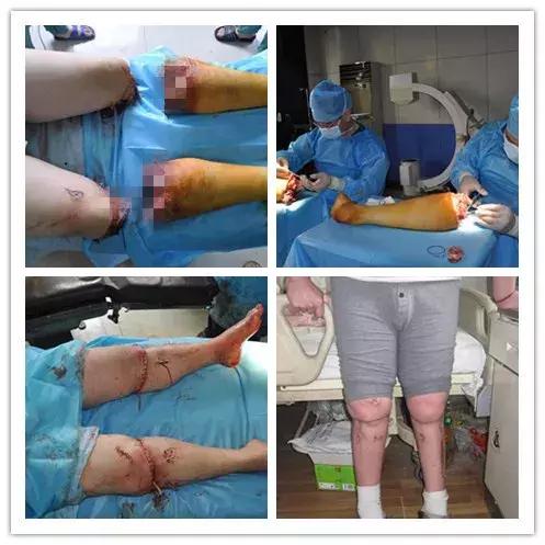 邯郸骨科医院成功为一被六吨钢板砸伤的危重患者进行右足再造手术