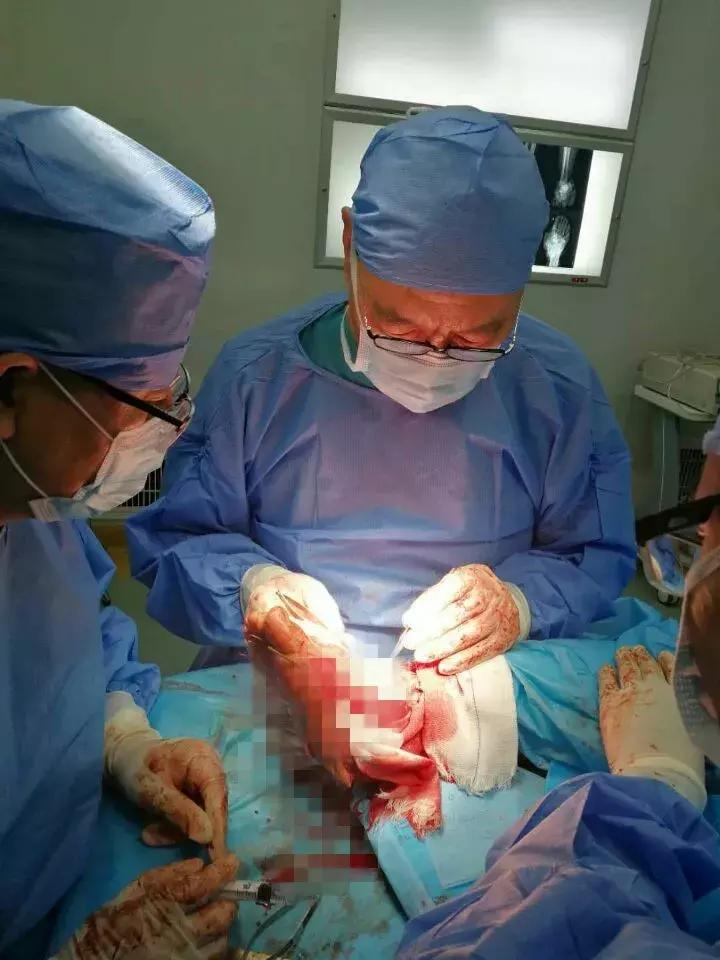 邯郸骨科医院成功为一被六吨钢板砸伤的危重患者进行右足再造手术