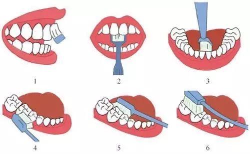 预防儿童龋齿涂氟还是窝沟封闭,有一点龋齿不想做窝沟封闭会怎样