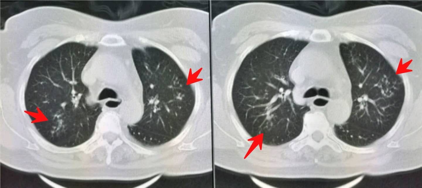 胃胀反酸导致嗓子发炎咳嗽,咽喉肿痛咳嗽吞口水都疼