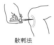 中医针刺疗法视频大全,三棱针的常用针刺方法