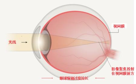 远眺有利于缓解散光吗,远眺对近视的好处
