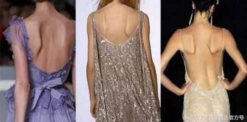 翼状肩胛骨矫正最快的方法,翼状蝴蝶骨矫正