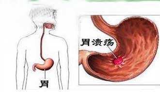 胃溃疡性质病变是指什么呢,胃溃疡的病因是什么如何治疗