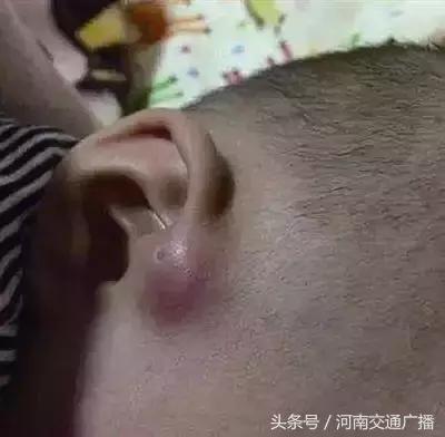 宝宝耳朵长出聪明孔,婴儿耳朵边长了小肉球