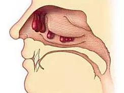 得了鼻息肉闻不着味儿怎么办,判断鼻息肉最简单方法