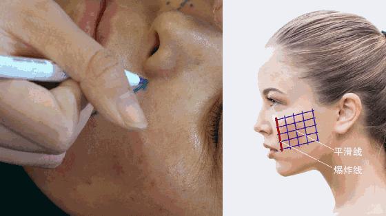 面部线雕失败全过程,面部线雕失败的图片