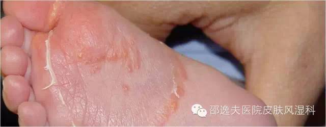 脚气真的不能治吗,脚气真的治不好吗知乎