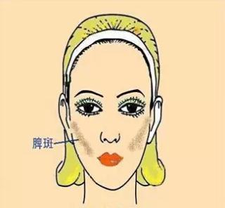 如何识别各种不同的斑,不同位置的色斑叫什么