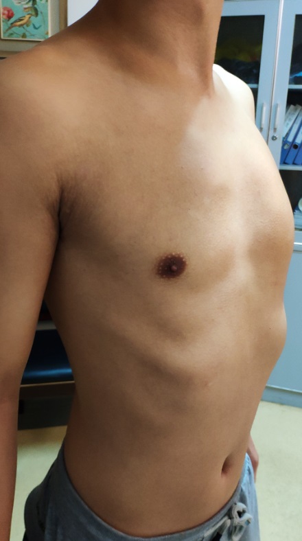 鸡胸微创手术是怎么做的,微创鸡胸矫正