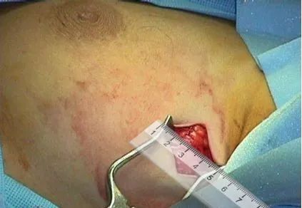 徐州哪个医院做乳腺微创手术最好,医大一院乳腺微创手术谁做的好