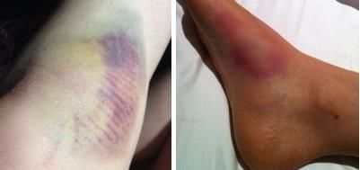 日本治疗创伤性关节炎,治疗关节炎的日本进口药