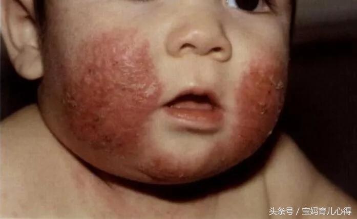 宝宝常见皮肤病家长们看过来,宝妈必须知道的五种皮疹