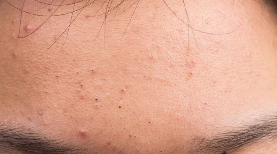 痘痘一直不好怎么办,痘痘一直不好要去医院做什么测试