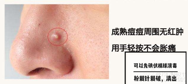 最可怕的痘痘,痘痘不可怕泛红才可怕