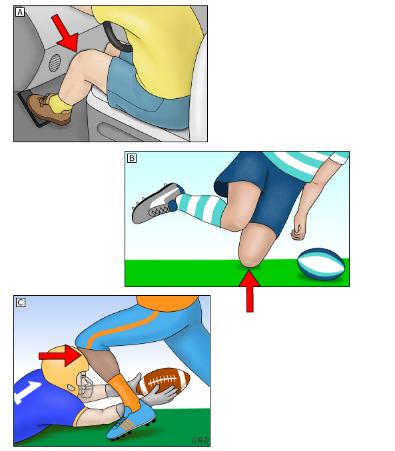 膝关节韧带损伤最佳治疗方法,膝关节韧带损伤有啥治疗秘方吗